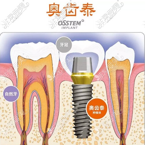 韓國奧齒泰種植牙宣傳圖