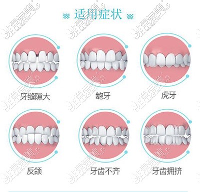 隐形牙齿矫正适应症状