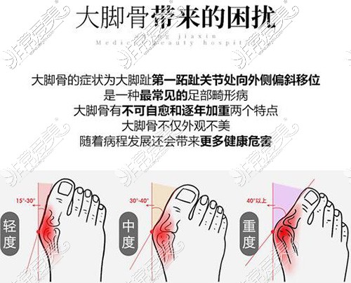 大脚趾旁边骨头凸起怎么矫正,国内哪个医院可以做脚整形?