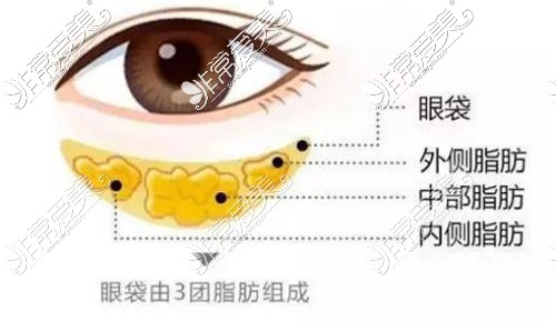 眼袋由3团脂肪组成