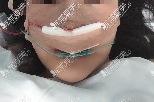 郑州美莱肋骨鼻综合整形手术方案设计
