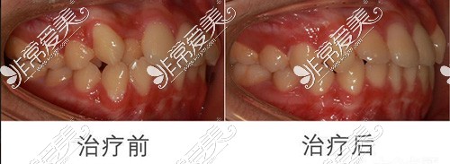宜昌牙齿矫正多少钱?内附宜昌2021牙齿矫正价格表!