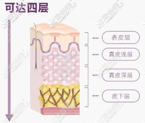 欧洲之星Fotona4D分层抗衰