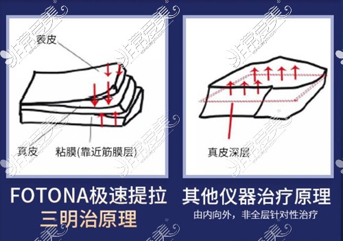 歐洲之星Fotona4D抗衰<span style=