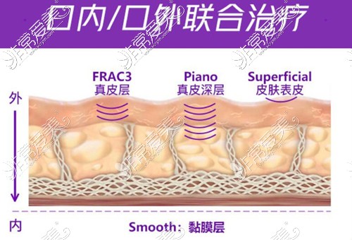 欧洲之星Fotona4D抗衰真有网传那么好?有没有副作用和危害?