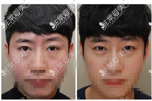 韩国可来熙整形外科医院男士双眼皮改单眼皮术后