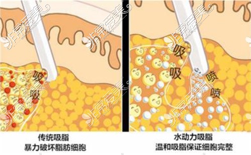 武汉抽脂一般多少钱?分门别类给您汇总武汉抽脂效果好医院!