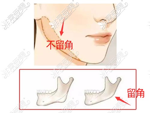 下颌角不留角图片