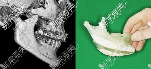 下颌角切多了现在没了还可以修复不？除了人工骨还能选谁