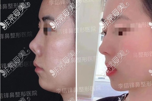 深圳星颜医疗美容鼻修复对比照