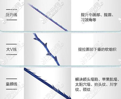 不同材料做埋线手术优势