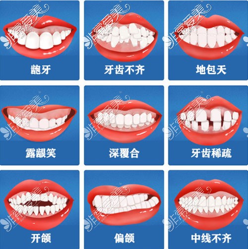 需要进行牙齿矫正的部分情况