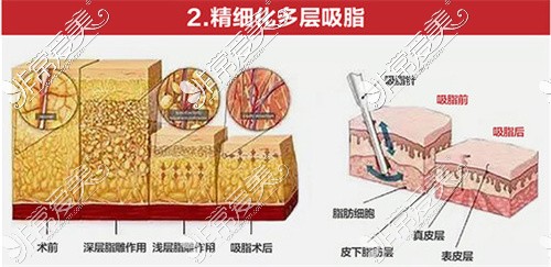 武汉艺星抽脂效果怎么样?武汉艺星抽脂医生杨斐技术厉害吗!