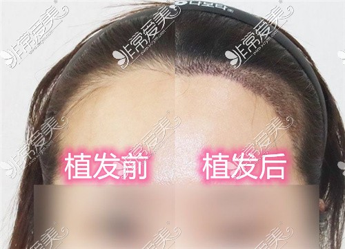 潍坊哪里植发比较好?当地人推荐这3家毛发成活率高价格不贵