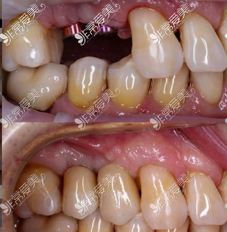 种植牙牙龈瓷效果图图片