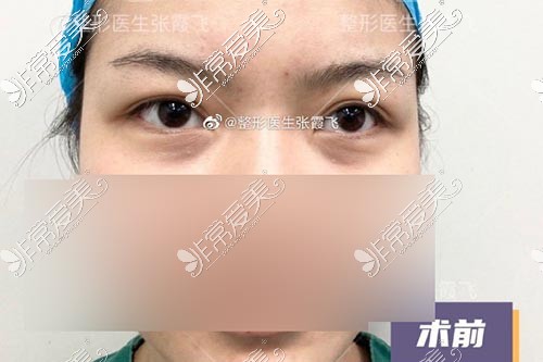 杭州割双眼皮哪家医院好点？格莱美张霞飞做眼睛真的好吗