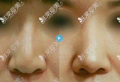 鼻假体歪斜修复前后对比