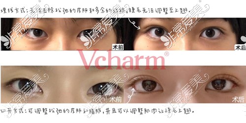 嘉兴Vcharm曙光医院割双眼皮怎么样？好不好、多少钱透漏下