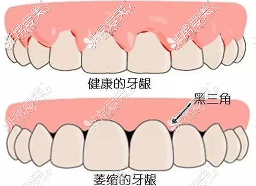 为什么很多医生说矫正牙齿先要片切，片切是不是很可怕？