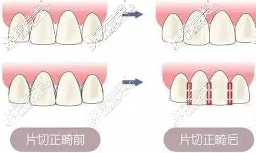 为什么很多医生说矫正牙齿先要片切，片切是不是很可怕？