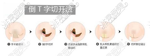 倒T字切开法乳房缩小过程