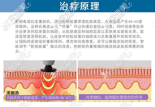 大连爱德丽格热玛吉价格贵吗?四代全面部900发需要多少钱