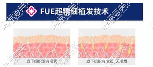 广州荔湾区人民医院植发技术