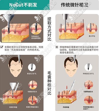 传统微针植发优势