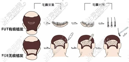 無痕植發(fā)技術(shù)與有痕植發(fā)技術(shù)區(qū)別