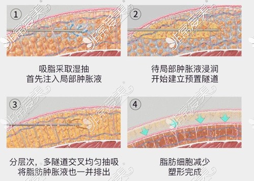 上海华美整形医院大腿吸脂过程