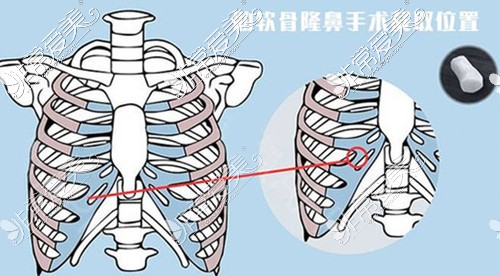 兰州时光整形肋骨鼻