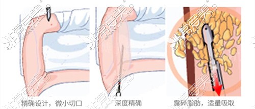 廈門Vmax薇格整形手臂吸脂優(yōu)勢