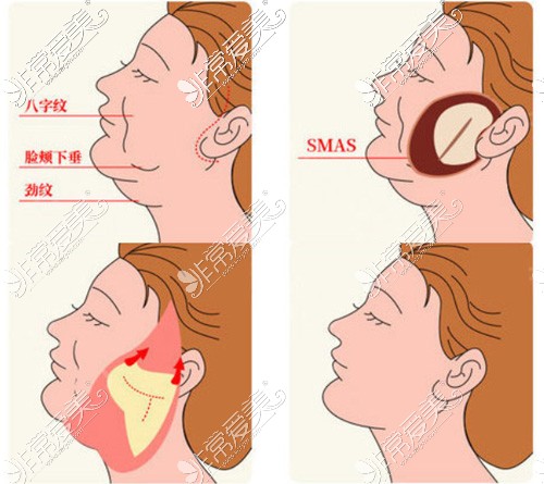 面部拉皮手术介绍