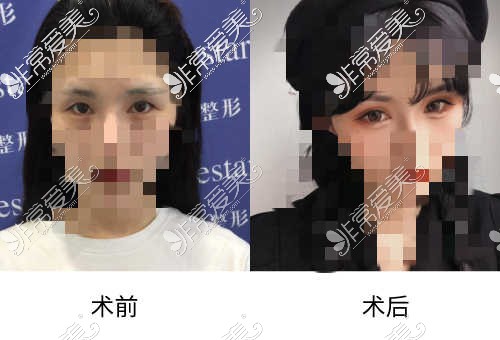 宁波艺星时代整形美容医院怎么样正规吗?眼鼻整形价格表