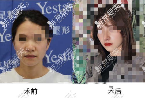 宁波艺星隆鼻手术术前术后