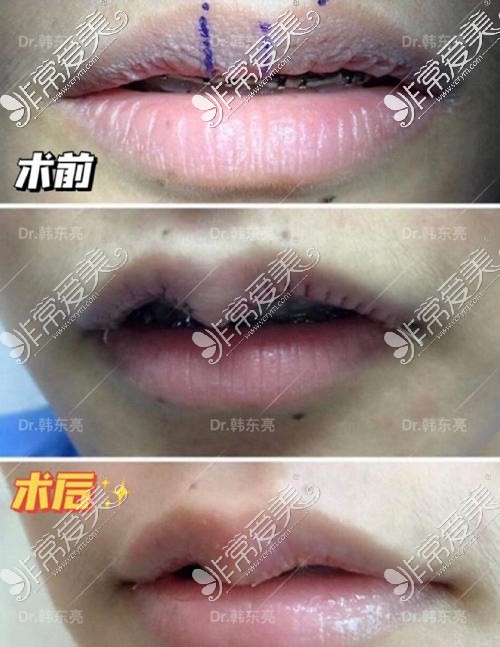韩东亮医生厚唇改薄手术前后对比照片