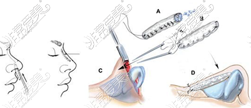 隆鼻方式图