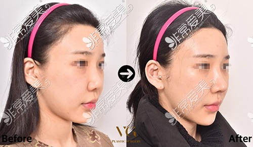 韩国VG整形外科隆鼻前后对比