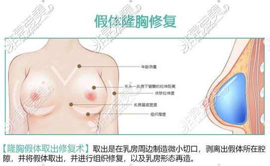 昆明胸部修复哪家好?公布本地隆胸修复医生以及修复价格!