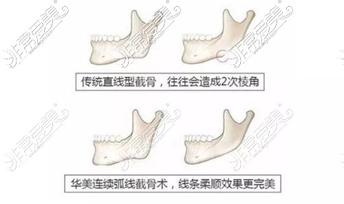 重庆时光整形姜民范怎么样?磨骨手术风格特色及价格告诉你