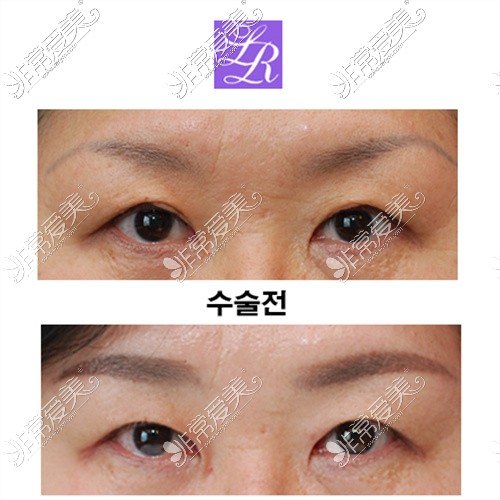 韩国莱丽医院双眼皮修复