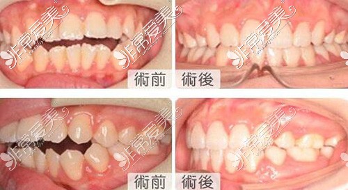 牙齿错颌正畸前后对比照片