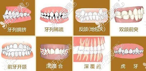 哪些牙齿需要做矫正改善