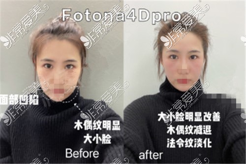 医美界摸爬滚打10年的人告诉你欧洲之星fotona4dpro值得做吗！