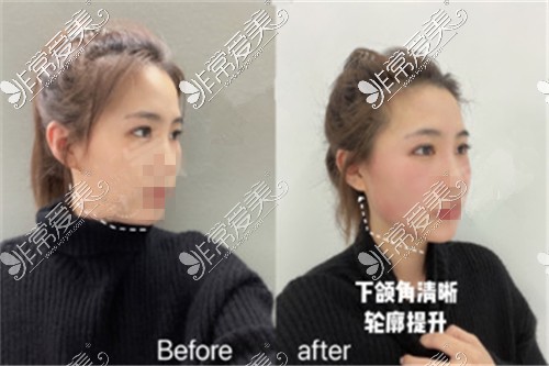 医美界摸爬滚打10年的人告诉你欧洲之星fotona4dpro值得做吗！