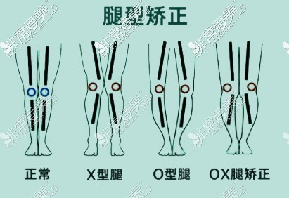 各种腿型分类