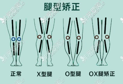 杭州腿型矫正医院有哪些?想要黄金比例腿型这家别错过!