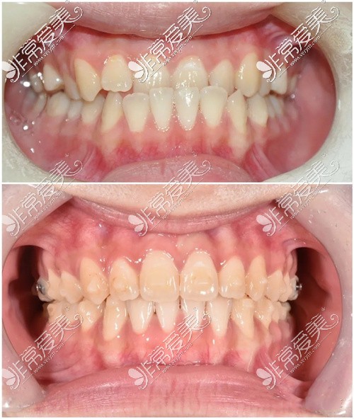 武汉德韩口腔隐形矫正对比