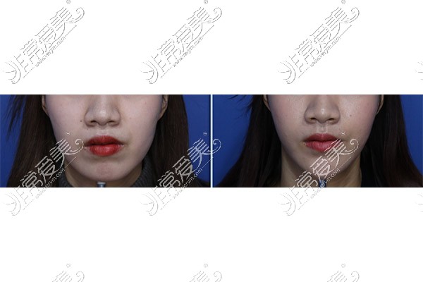 韩国V脸提升手术效果图