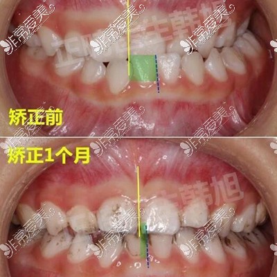 儿童牙齿偏颌改善照片